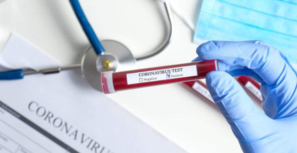 Virus korona potvrđen kod 344 osobe u Srpskoj
