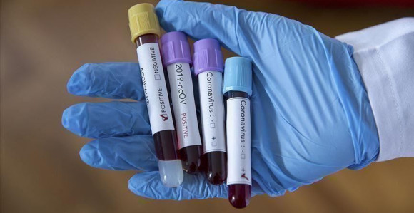 U Srpskoj još 425 osoba zaraženo virusom korona