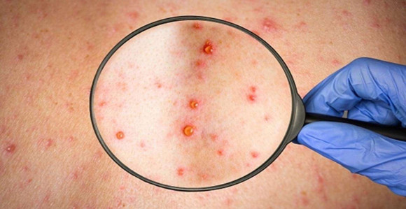 Prvi pacijent u BiH zaražen majmunskim boginjama