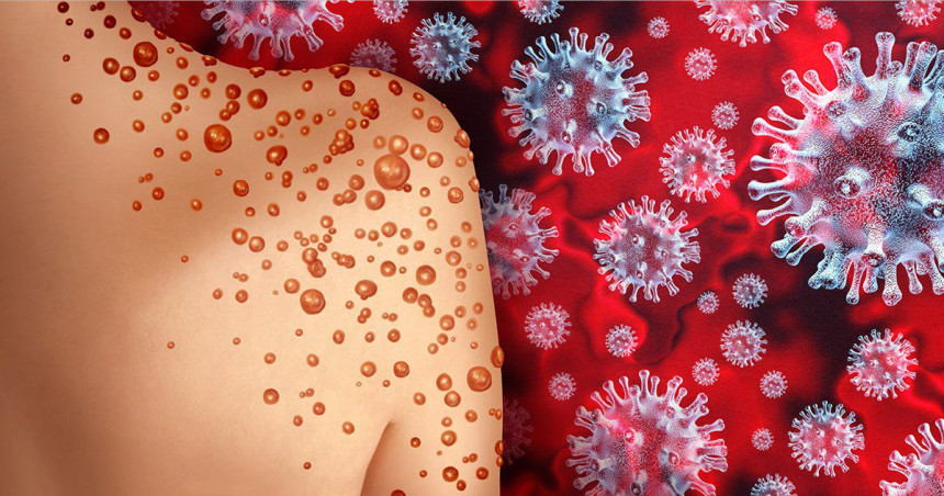 SZO: Vanredna situacija zbog majmunskih boginja