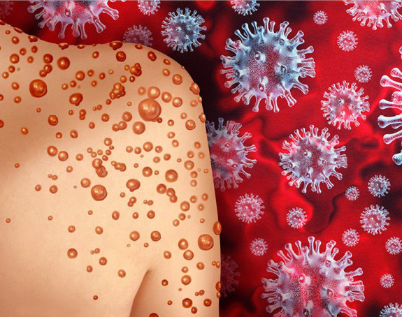 SZO: Vanredna situacija zbog majmunskih boginja