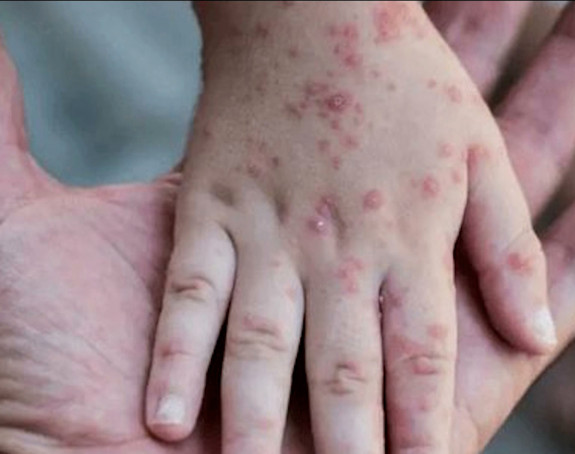 Majmunske boginje – izgled, simptomi i dijagnostika