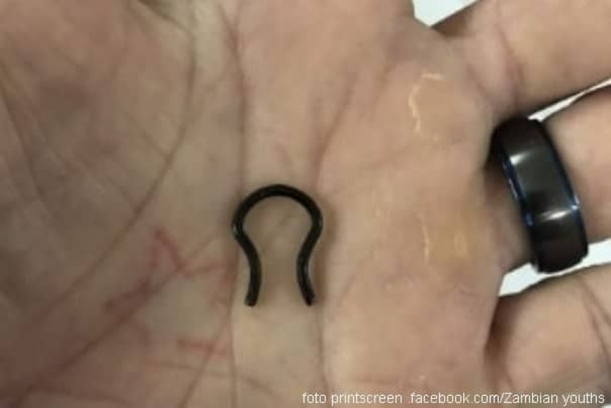 Pirsing iz nosa mu završio u plućima!?