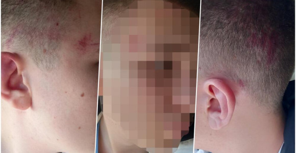 Četiri Albanca pretukla srpskog dječaka na KiM