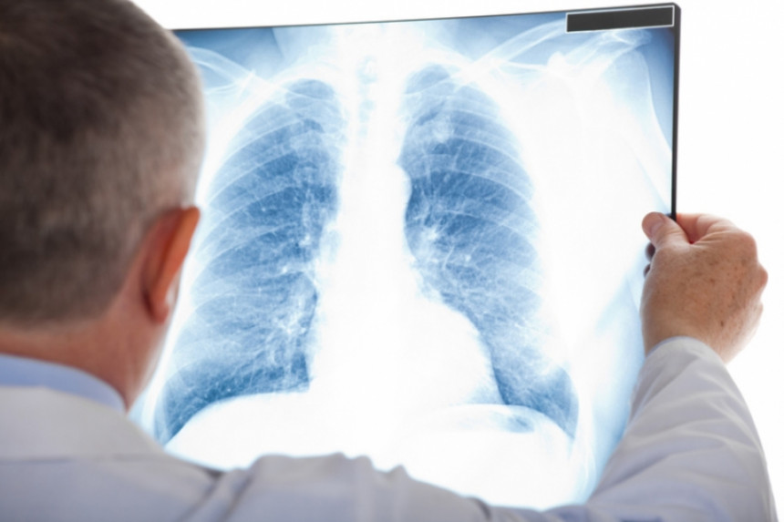 Analize pokazale velike sposobnosti kancera pluća