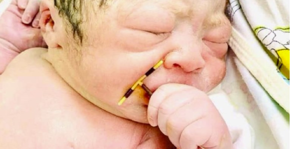 Ispravka: Netačno da je beba rođena sa spiralom u ruci! (FOTO)