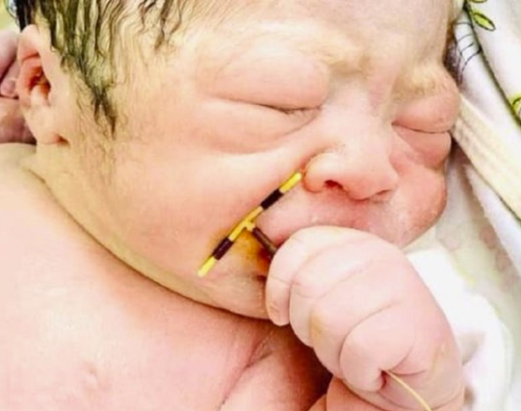 Исправка: Нетачно да је беба рођена са спиралом у руци! (ФОТО)