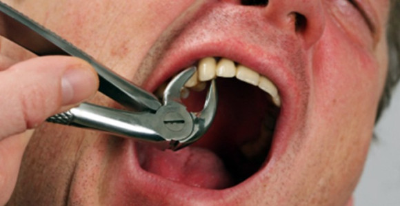 Čistač se lažno predstavio kao zubar i izvadio čoveku 4 zuba!
