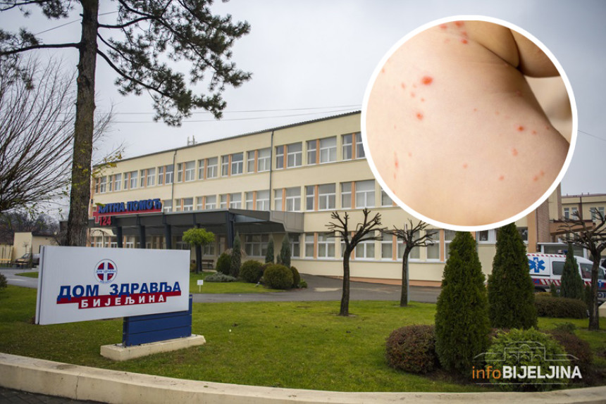 Institutu prijavljena epidemija morbila u Semberiji