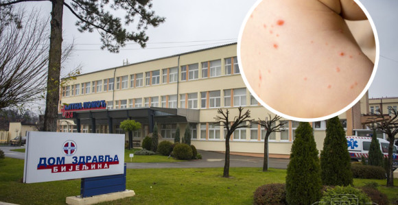 Institutu prijavljena epidemija morbila u Semberiji