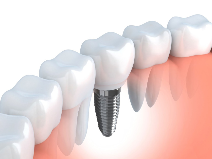Zubar mu hteo ugraditi implant pa probio mozak?!