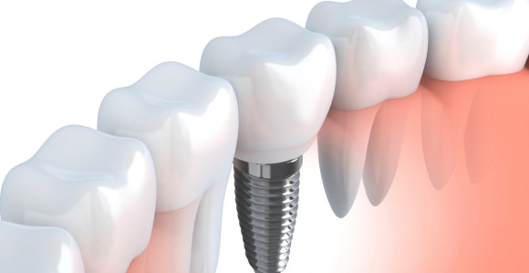 Zubar mu hteo ugraditi implant pa probio mozak?!