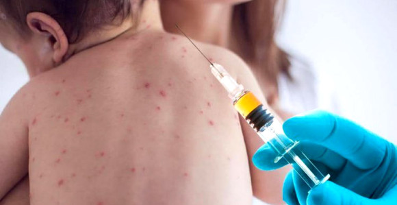 Morbilama zaraženo 241 lice, čak 172 u Bijeljini