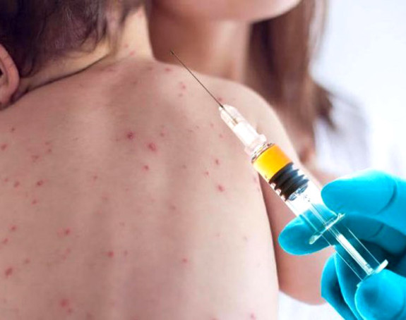Morbilama zaraženo 241 lice, čak 172 u Bijeljini