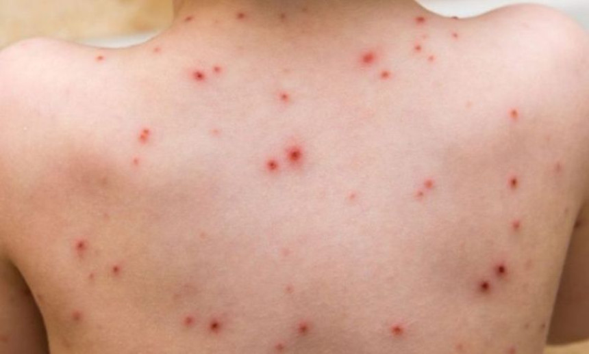 Apel SZO I UNICEF-a BiH za rješavanje epidemije morbila