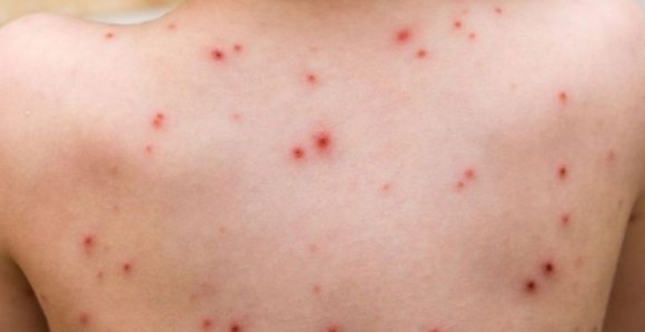 Apel SZO I UNICEF-a BiH za rješavanje epidemije morbila