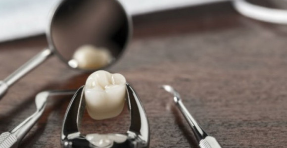 Čovjek umro: izvađeno mu 20 zuba za 24h