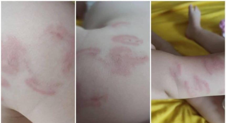 Sarajevo: Slučaj bebe koju su 14 puta izgrizli u vrtiću...