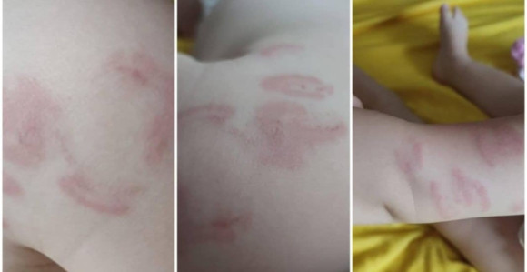 Sarajevo: Slučaj bebe koju su 14 puta izgrizli u vrtiću...