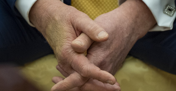 Koliko je ozbiljno oboljenje vena od kog pati Tramp?