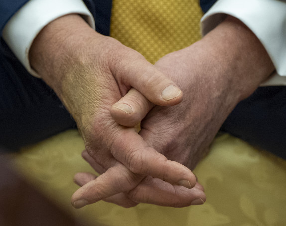 Koliko je ozbiljno oboljenje vena od kog pati Tramp?