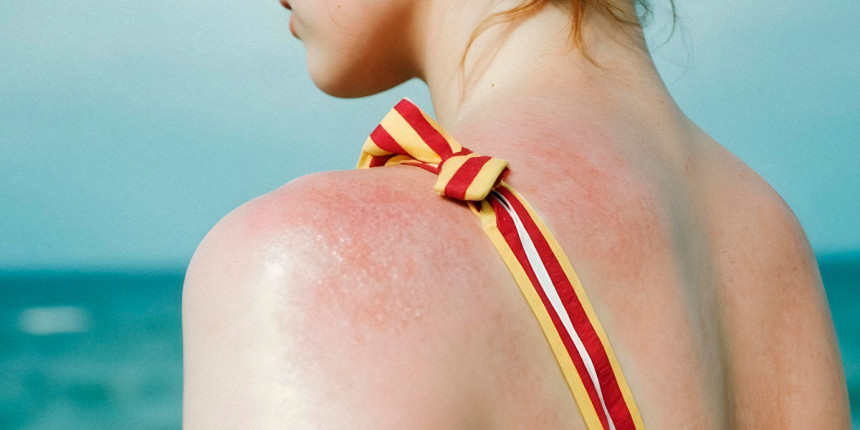 Znate li šta je solarna urtikarija?