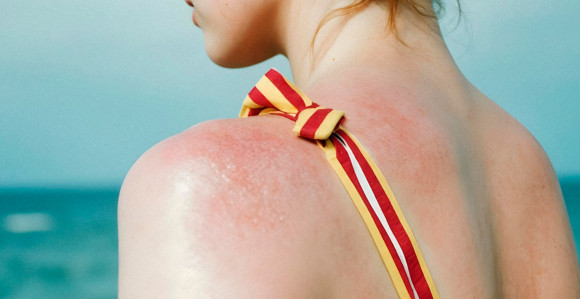 Znate li šta je solarna urtikarija?