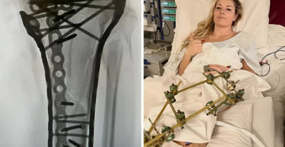 Šraf do šrafa: Ovako sada izgleda noga Lindzi Von (VIDEO)