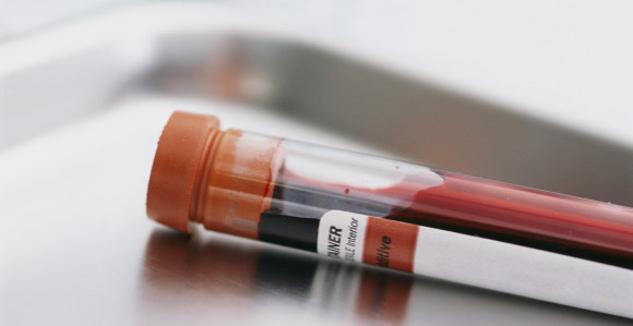 Testovi krvi će pokazivati da li su nam potrebni antibiotici