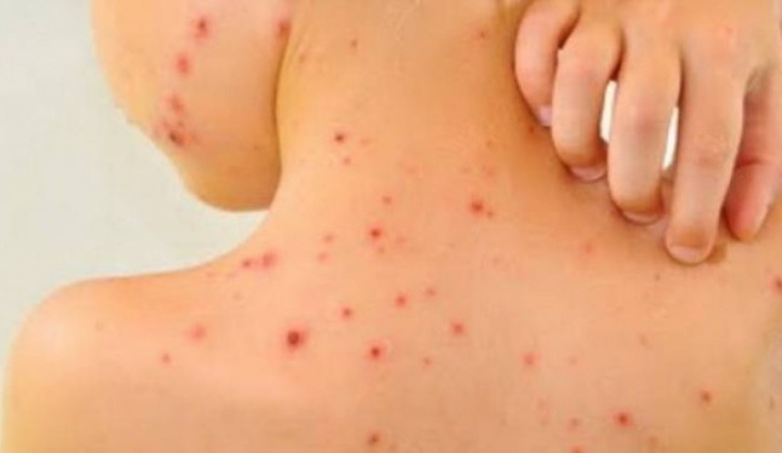 U RS 42 oboljelih od morbila