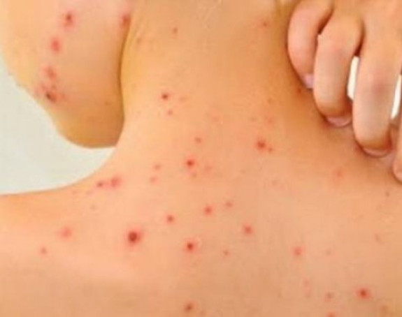 U RS 42 oboljelih od morbila