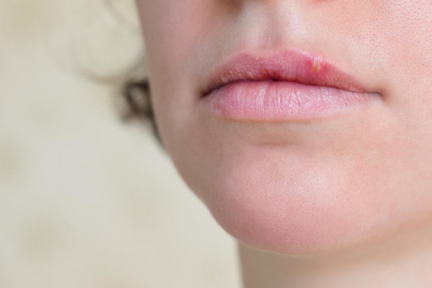 Herpes ne smijete prikrivati šminkom