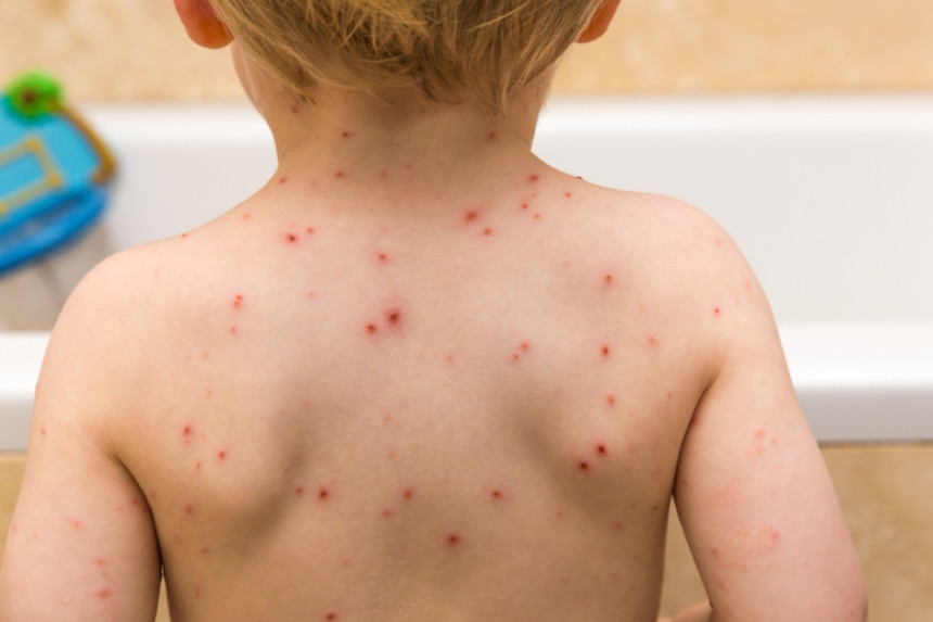 Mjere protiv epidemije boginja