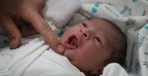 U Bijeljini rođena beba sa dva prednja zuba