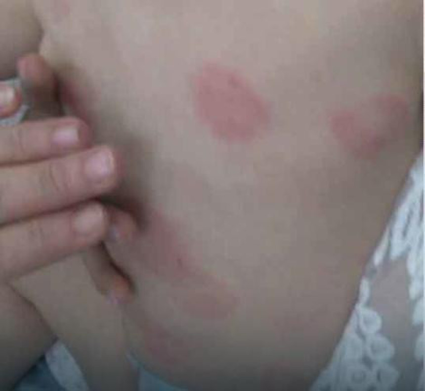 Izujedana beba u vrtiću 