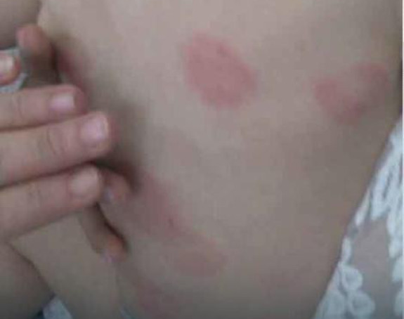 Izujedana beba u vrtiću 