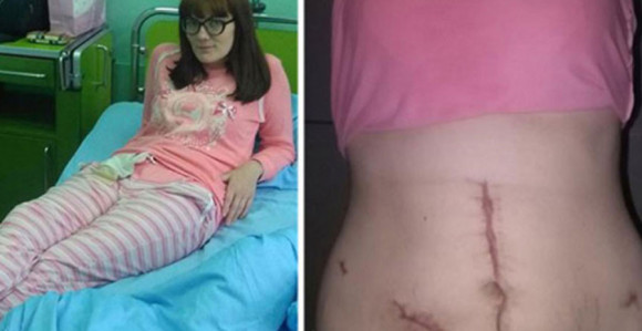 Zaboravili gazu u stomaku nakon carskog reza