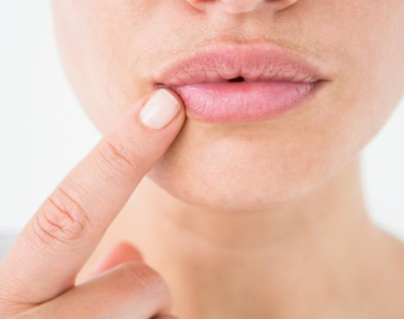 Šta otkrivaju ispucale usne?