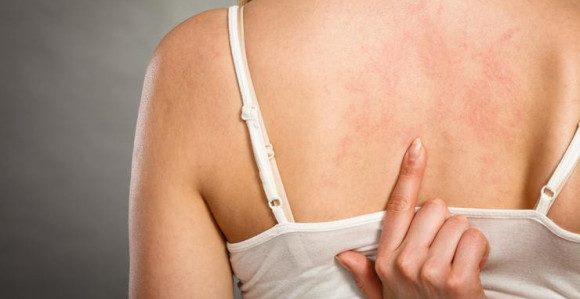 Najopasnije je kada alergija izazove gušenje