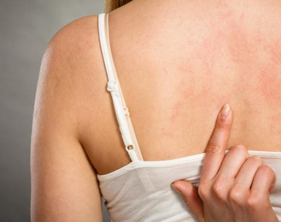 Најопасније је када алергија изазове гушење