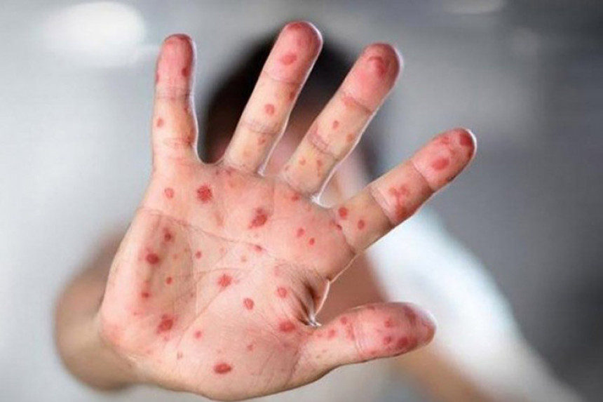 U Banjaluci prvi slučaj morbila  