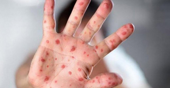 U Banjaluci prvi slučaj morbila  