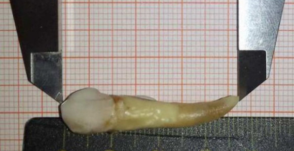 Nemački zubar izvadio pacijentu zub od skoro 4 cm!