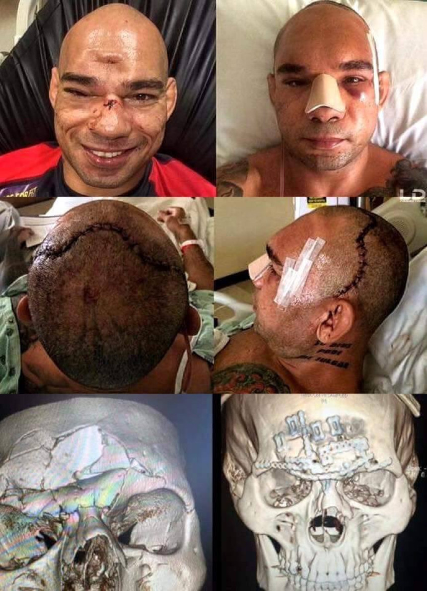 Nije lijep prizor! Ovako izgleda glava MMA borca nakon sedmočasovne operacije!